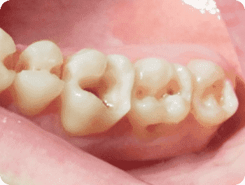 Удаление зубов у детей
