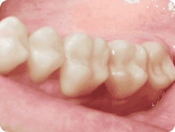 Лечение зубов под седацией